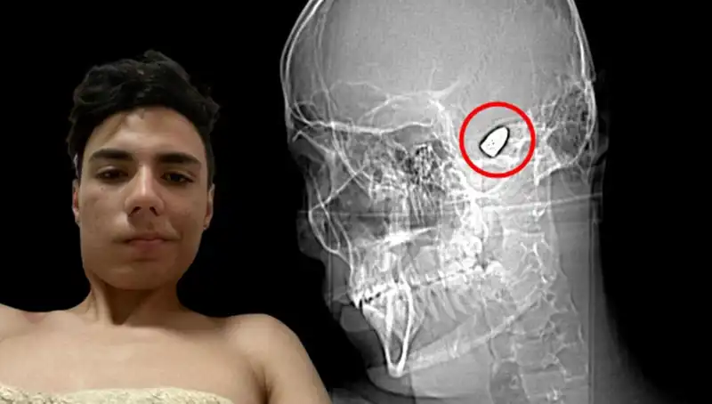 Kafasında Patlayıcıyla Yaşayan Genç Kadın: Dramatik Hikaye