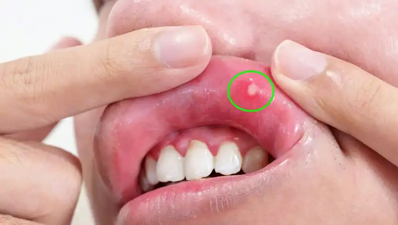 B vitamini Eksikliği: Belirtileri ve Sağlığınıza Olan Etkileri