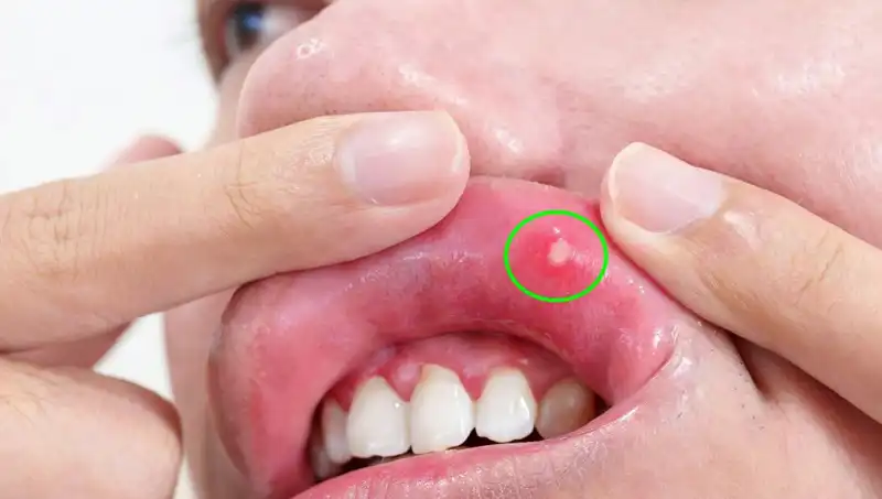 Kanserin Tehlikeli Belirtilerini Göz Ardı Eden Genç Kadın Zorlu Sürece Girdi