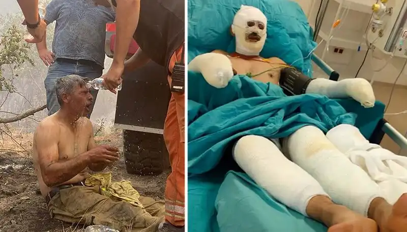 Orman İşçisinden Korkutan Feryat: "Yanıyorum" Dedi, Tedavisi Devam Ediyor